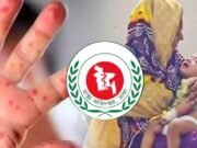 হাম উপসর্গ নিয়ে আরও ৩ শিশুর মৃত্যু