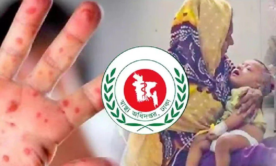 হাম উপসর্গ নিয়ে আরও ৩ শিশুর মৃত্যু