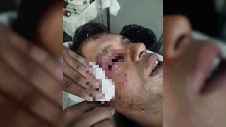 ট্রেনে পাথর নিক্ষেপ, চোখ হারালেন আইনজীবী