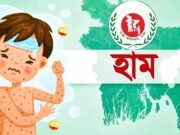 হাম উপসর্গে আরও ৪ শিশুর মৃত্যু, মোট প্রাণহানি ৮৯৪