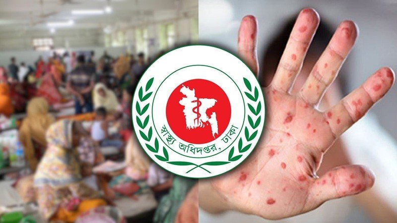 হাজার ছাড়াল হামজনিত শিশুমৃত্যু