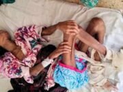 শিক্ষিকার বাসায় নির্যাতন, ক্ষত-ছ্যাঁকার দাগে কাতর শিশু তানিয়া